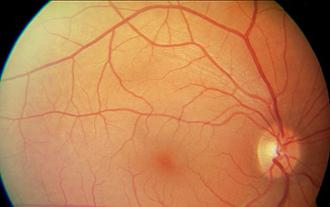 Fondo de ojo para Retina y glaucoma