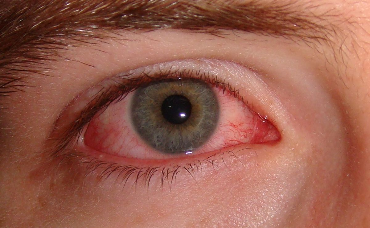 Conjuntivitis: 5 respuestas a preguntas frecuentes.