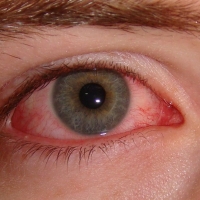 Conjuntivitis: 5 respuestas a preguntas frecuentes.